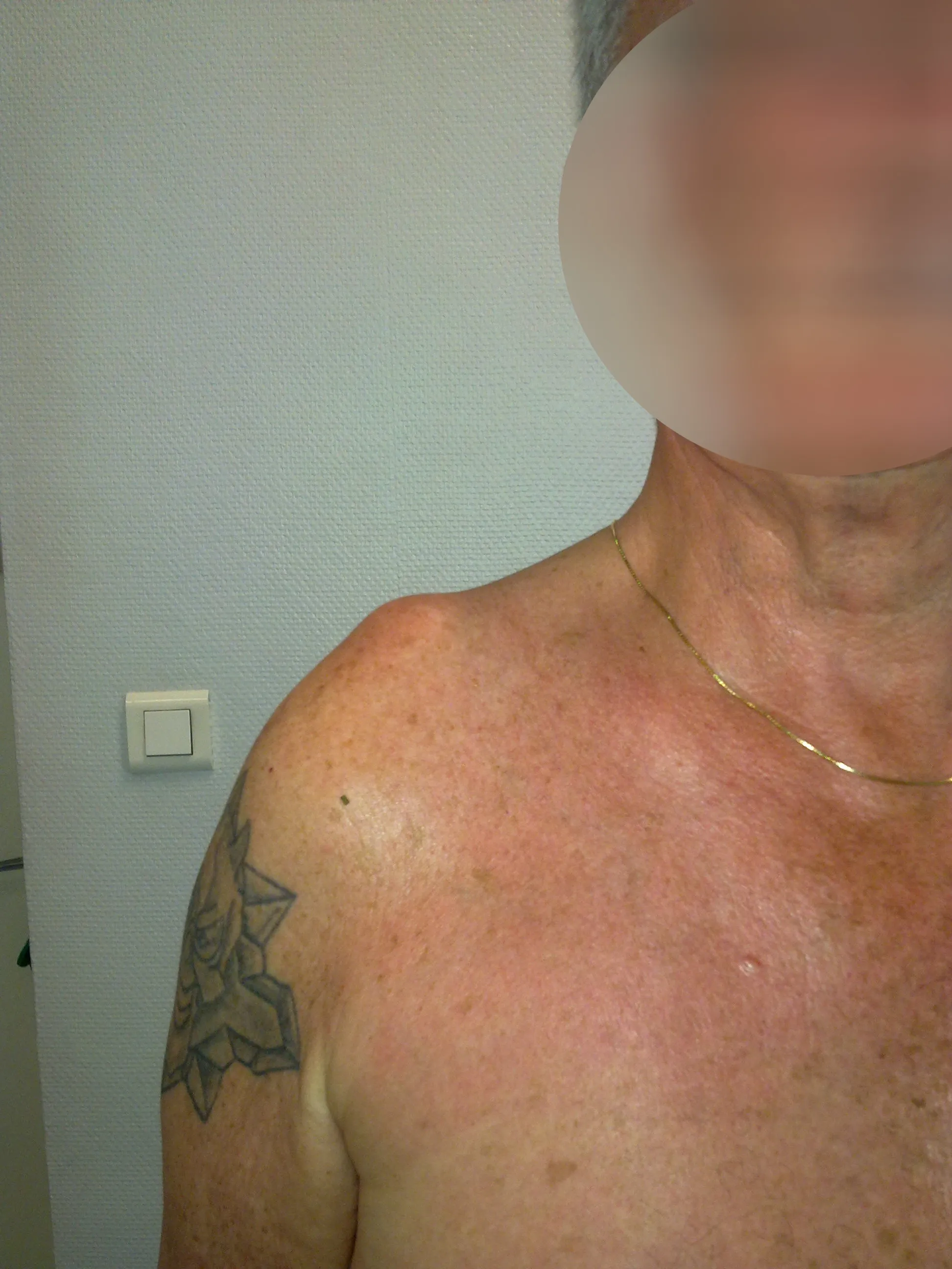 Douleurs bras, traitements