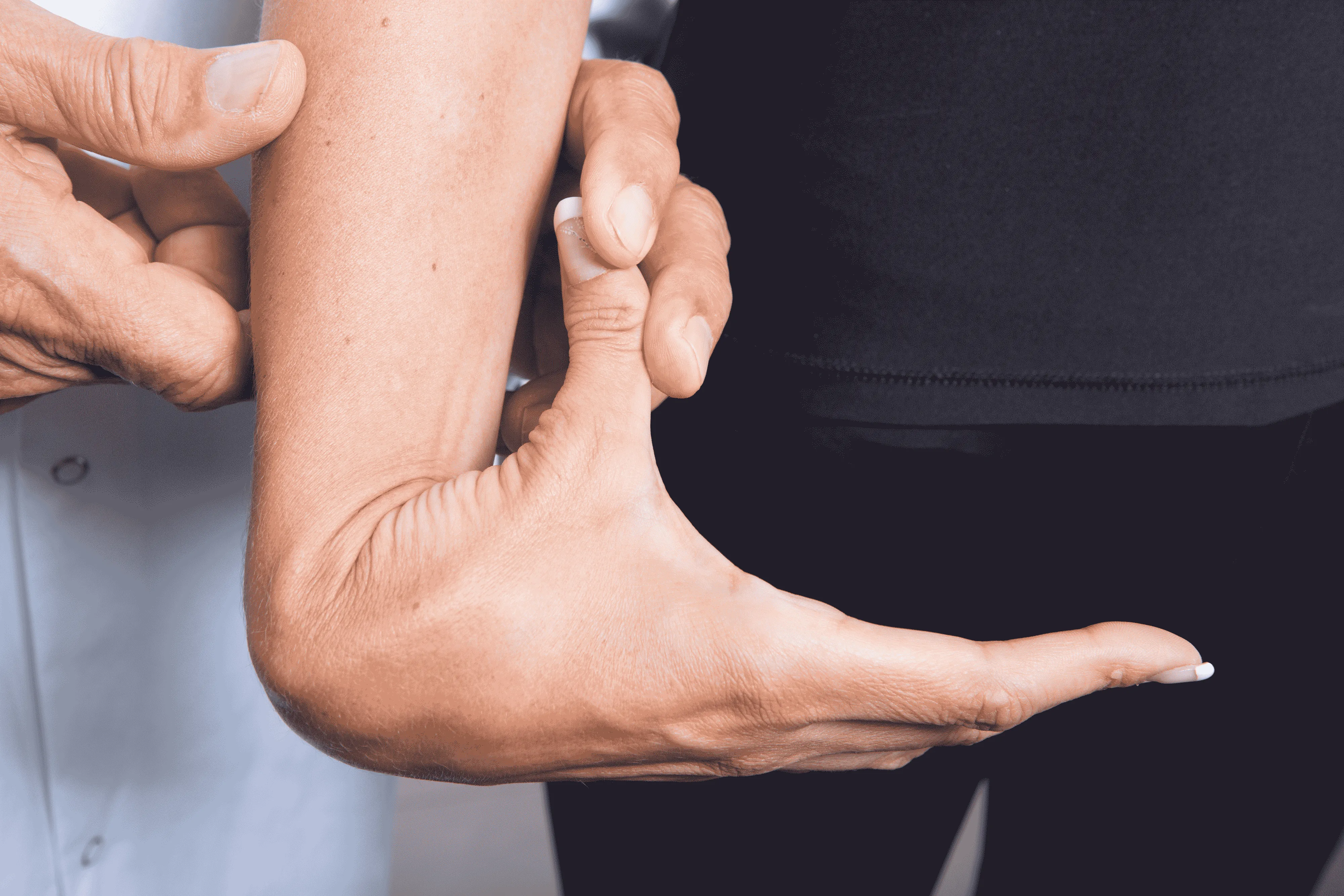 Hyperlaxité ligamentaire